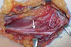 ترقيع العصب المجهري