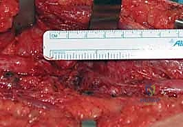 دقة الجراحة المجهرية