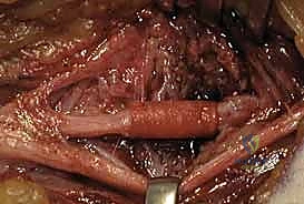 الدكتور محمد هطيف أثناء عملية جراحية معقدة