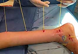 الإصلاح الجزئي للعصب - خطوة 1