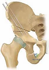 Triple Innominate Osteotomy