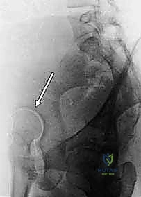 جراحة قطع عظم الحوض الثلاثي (TIO) لعلاج خلل تنسج الورك: دليل شامل للمرضى مع الأستاذ الدكتور محمد هطيف