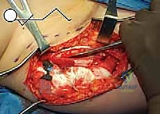 قياس زوايا مفصل الورك قبل الجراحة