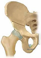 الأشعة السينية لتشخيص زوايا الورك