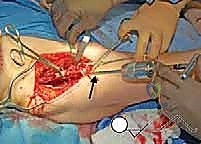 العلاج الطبيعي في الأسابيع الأولى بعد الجراحة