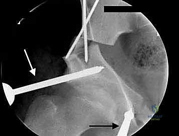 العودة للمشي الطبيعي بعد التعافي التام