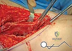 صورة أشعة تظهر التحام العظام بعد الجراحة