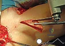 تمارين تقوية العضلات في المرحلة الثانية