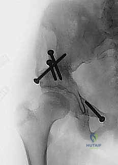 صورة قبل وبعد الجراحة لمريضة خلل تنسج