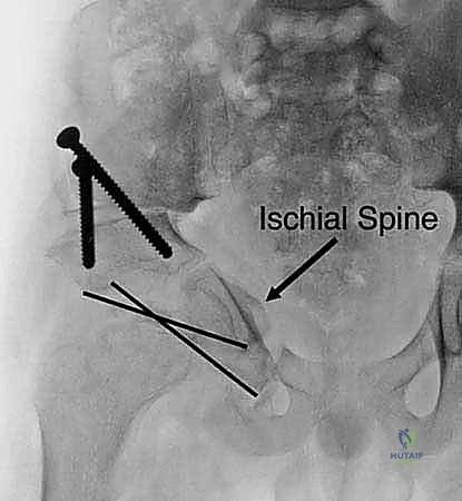 الندبات الجراحية التجميلية بعد التعافي