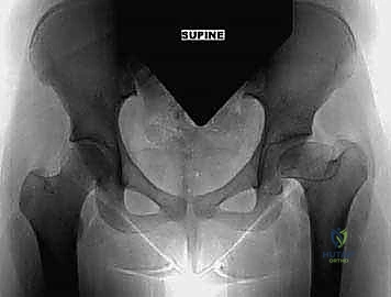 خطوات إجراء القطع العظمي وإزاحة الحوض إنسياً في جراحة كياري