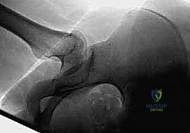 جراحة كياري لتغيير موضع الحُق: حل متقدم لخلل التنسج الوركي في اليمن