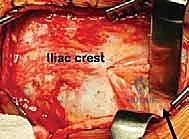 Illustration of chiari medial displacement - Dr. Mohammed Hutaif