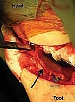 Mastering the Chiari Medial Displacement Osteotomy: An Intraoperative Masterclass for Acetabular Dysplasia