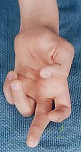 صورة توضيحية لـ جراحة نقل الأوتار لشلل العصب الأوسط: استعادة وظيفة اليد وحياة طبيعية