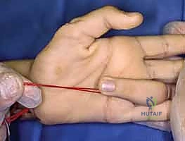 تشريح اليد والعصب الأوسط