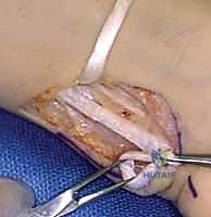 أسباب شلل العصب الأوسط