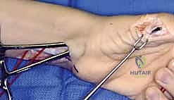 تأثير إصابة العصب الأوسط على العضلات