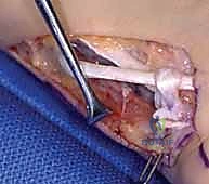 أعراض شلل العصب الأوسط وفقدان القدرة على القرص