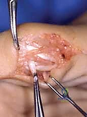 الضغط المزمن على العصب الأوسط