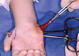 مبادئ جراحة نقل الأوتار