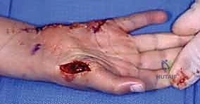 تقنيات نقل الأوتار المختلفة