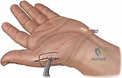 صورة طبية: جراحة نقل الأوتار لشلل العصب الأوسط: استعادة وظيفة اليد وحياة طبيعية