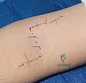 صورة توضيحية لـ جراحة نقل الأوتار لشلل العصب الأوسط: استعادة وظيفة اليد وحياة طبيعية