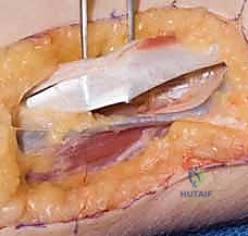صورة توضيحية لـ جراحة نقل الأوتار لشلل العصب الأوسط: استعادة وظيفة اليد وحياة طبيعية