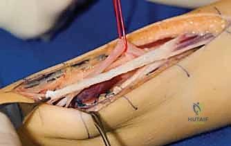 صورة توضيحية لـ جراحة نقل الأوتار لشلل العصب الأوسط: استعادة وظيفة اليد وحياة طبيعية