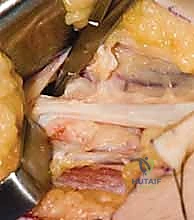 جراحة نقل الأوتار لشلل العصب الأوسط: استعادة وظيفة اليد وحياة طبيعية