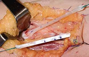 صورة طبية: جراحة نقل الأوتار لشلل العصب الأوسط: استعادة وظيفة اليد وحياة طبيعية