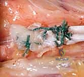 التخطيط الجراحي لنقل الأوتار