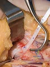 صورة طبية: جراحة نقل الأوتار لشلل العصب الأوسط: استعادة وظيفة اليد وحياة طبيعية