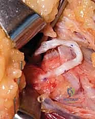 صورة طبية: جراحة نقل الأوتار لشلل العصب الأوسط: استعادة وظيفة اليد وحياة طبيعية