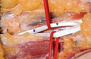 استخدام وتر العضلة السطحية المثنية