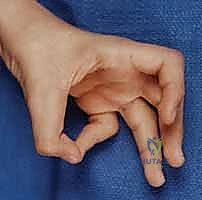 Illustration of median nerve palsy - Dr. Mohammed Hutaif