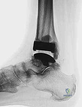 FIG 6  The TNK ankle replacement for rheumatoid arthritis of the ankle cemented replacement