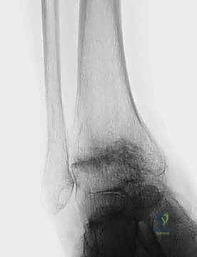 FIG 6  The TNK ankle replacement for rheumatoid arthritis of the ankle cemented replacement
