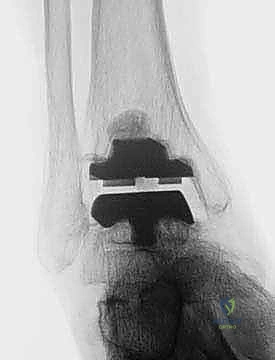 FIG 6  The TNK ankle replacement for rheumatoid arthritis of the ankle cemented replacement