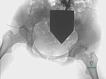 التخطيط الجراحي لقطع العظم