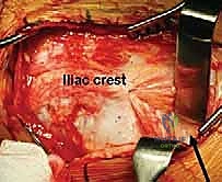 تحديد المعالم العظمية الدقيقة قبل القطع