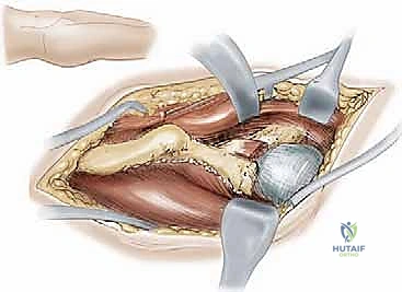الأستاذ الدكتور محمد هطيف أثناء إجراء تدخل جراحي دقيق