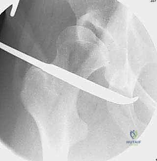 صورة طبية: قطع عظم حول الحُق البيرني: حل متقدم للحفاظ على مفصل الورك في صنعاء مع الأستاذ الدكتور محمد هطيف