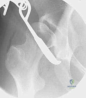 صورة طبية: قطع عظم حول الحُق البيرني: حل متقدم للحفاظ على مفصل الورك في صنعاء مع الأستاذ الدكتور محمد هطيف