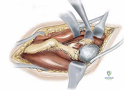 قطع عظم حول الحُق البيرني: حل متقدم للحفاظ على مفصل الورك في صنعاء مع الأستاذ الدكتور محمد هطيف