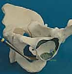 صورة توضيحية لـ قطع عظم حول الحُق البيرني: حل متقدم للحفاظ على مفصل الورك في صنعاء مع الأستاذ الدكتور محمد هطيف