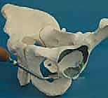 صورة توضيحية لـ قطع عظم حول الحُق البيرني: حل متقدم للحفاظ على مفصل الورك في صنعاء مع الأستاذ الدكتور محمد هطيف