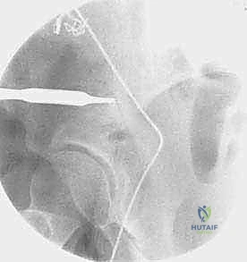 صورة توضيحية لـ قطع عظم حول الحُق البيرني: حل متقدم للحفاظ على مفصل الورك في صنعاء مع الأستاذ الدكتور محمد هطيف