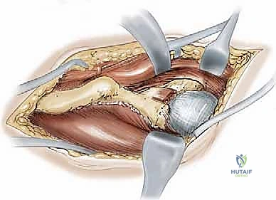 صورة طبية: قطع عظم حول الحُق البيرني: حل متقدم للحفاظ على مفصل الورك في صنعاء مع الأستاذ الدكتور محمد هطيف